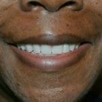 custom dentures near me - affordable dentures - partial dentures