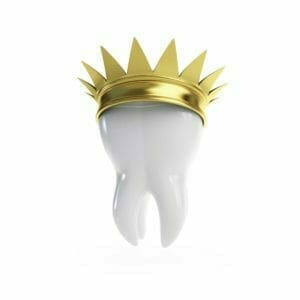 one hour crown - same day crowns near me - Murrieta dental crowns