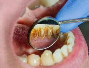 Dental Disease