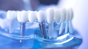 Murrieta dental implants Murrieta - one day dental implants near me