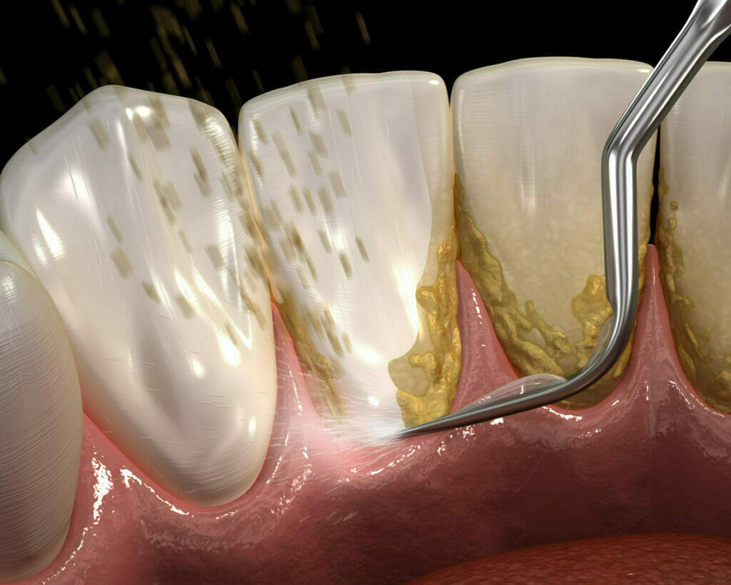 Ultrasonic teeth cleaning