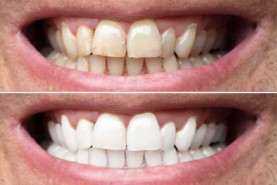 before and after dental veneer teeth