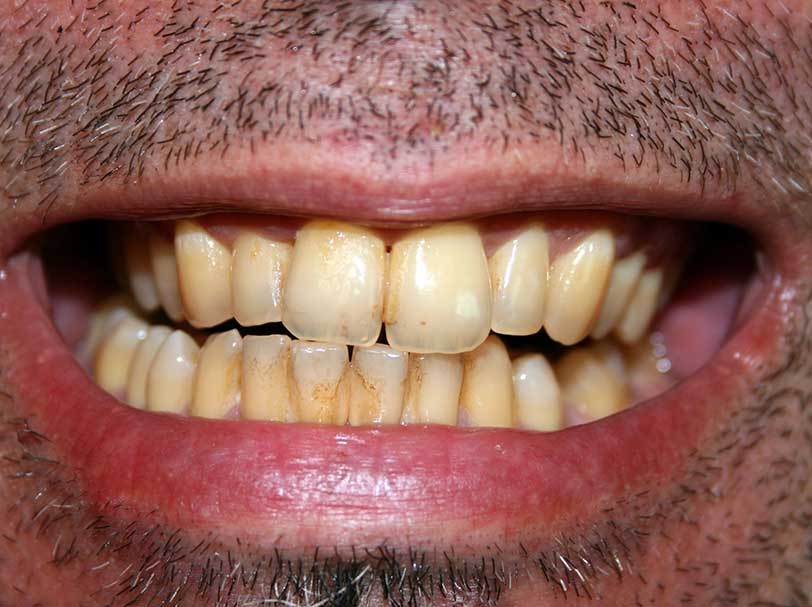 composite veneers