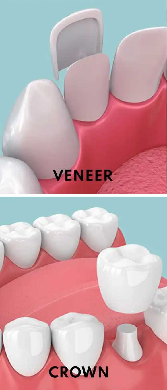 Veneers vs Crowns