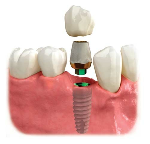 dental implants