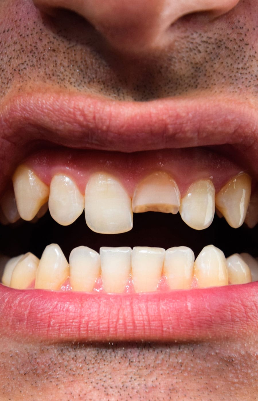 root canal after broken tooth