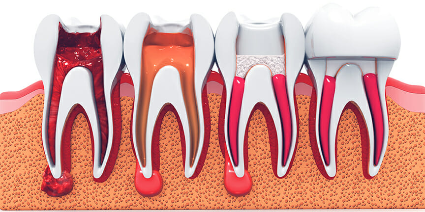 root canal