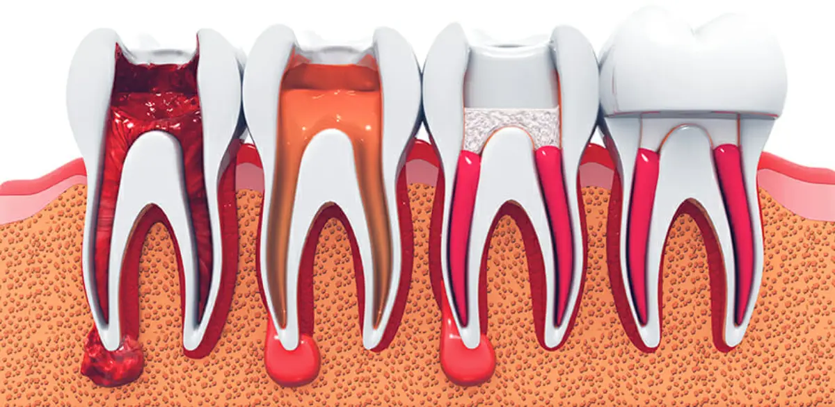 stages of root canals
