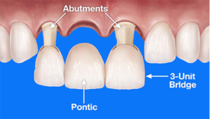 Murrieta dental bridge near me