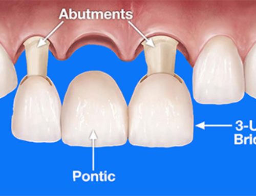 Murrieta Dental Bridges