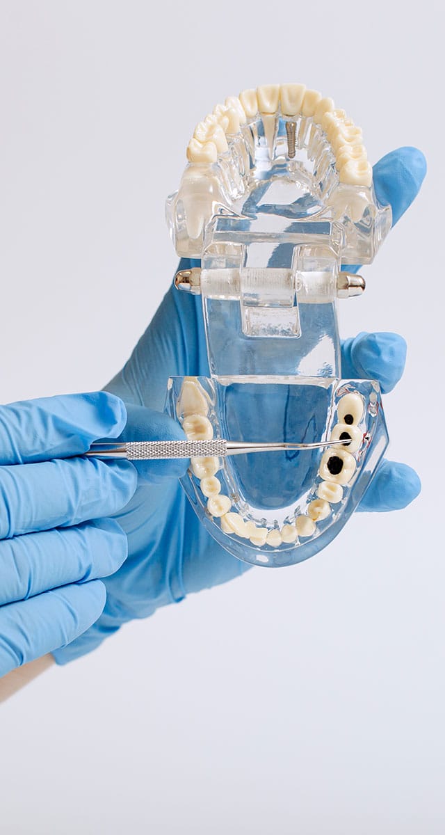 Murrieta dental bridge - affordable dental bridge