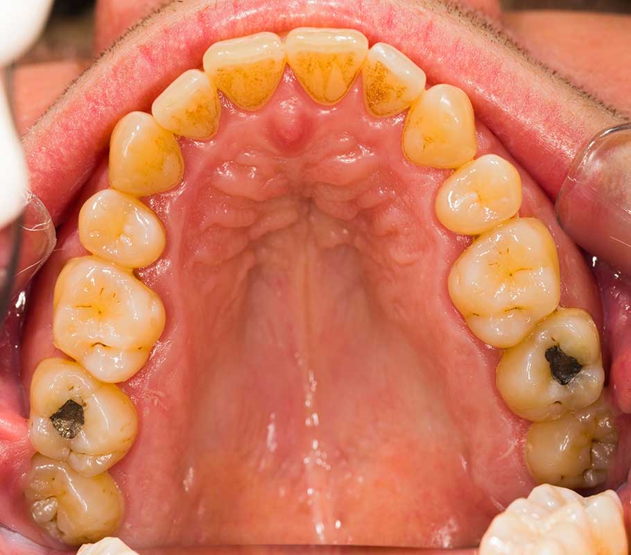 Murrieta teeth filling near me