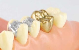 Murrieta same day crowns
