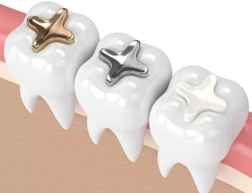 Murrieta Tooth Fillings