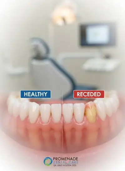 Close-up of an exposed tooth root caused by gum recession