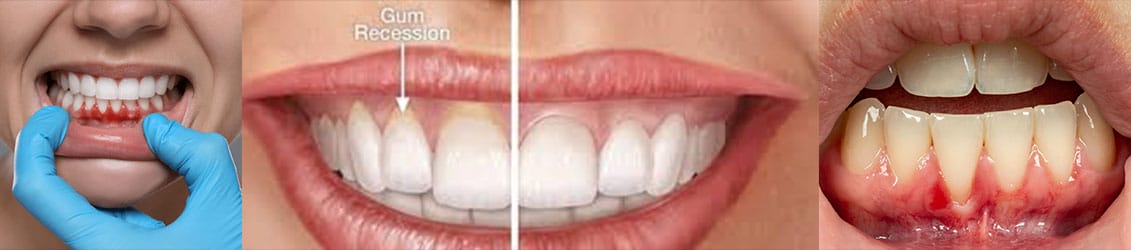 murrieta wisdom tooth extraction