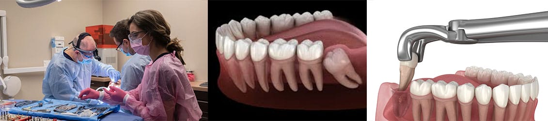 wisdom-tooth-extraction-banner murrieta wisdom tooth extraction