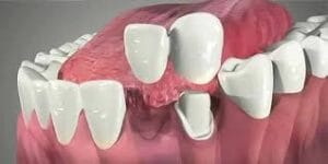 cantilever dental bridge