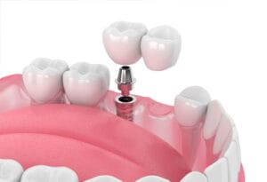 Implant Supported Dental Bridge
