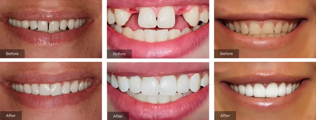 computer guided dental implants