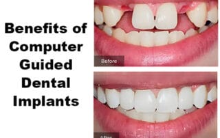 benefits of computer guided dental implants