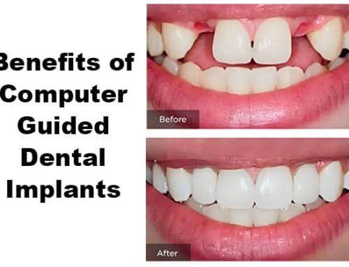 The Benefits of Computer-Guided Dental Implants