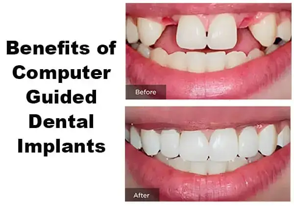 Illustration of a smile with two missing upper front teeth, shown before and after tooth replacement