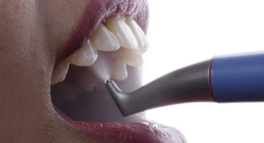 dental air polishing dental air polishing