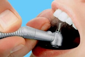 ultrasonic Teeth Cleaning