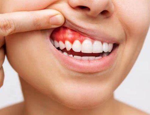 Early Gum Care for Cost-Effective Dental Health