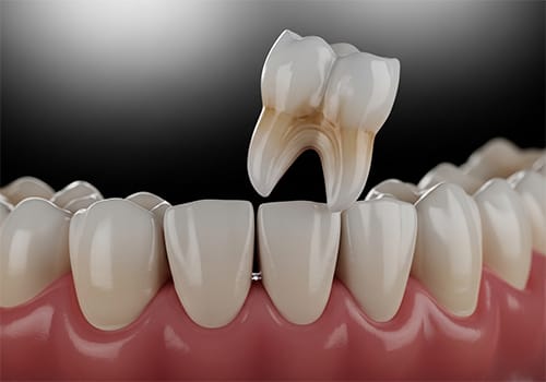 Murrieta wisdom teeth extraction