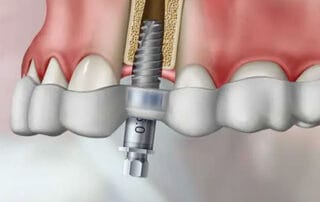 computer guided dental implants