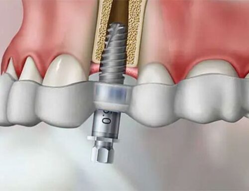 Promenade Murrieta Dental Announced Computer Guided Dental Implants