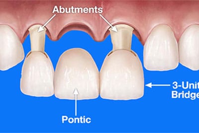 dental bridges