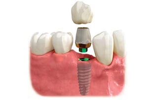 implant faqs