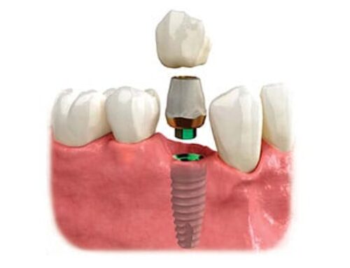 Frequently Asked Questions about Implants