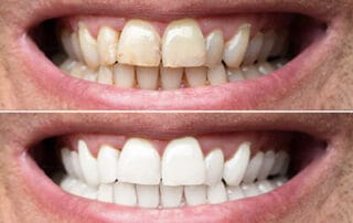 dental veneer faqs