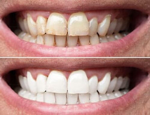 Dental Veneer Tips