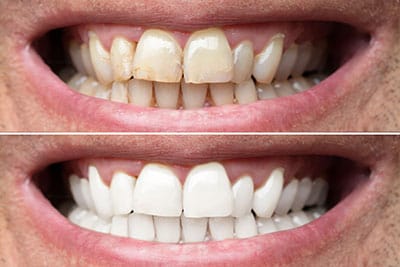 dental veneer faqs
