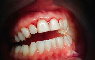 gum recession treatment
