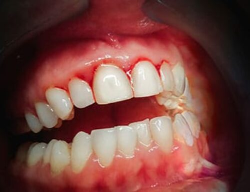 Gum Recession Treatment Tips