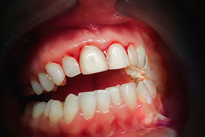 gum recession treatment