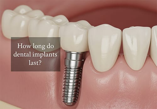 how long do dental implants last