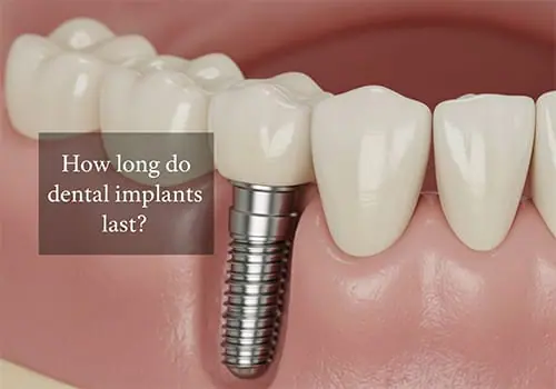 how long do dental implants last