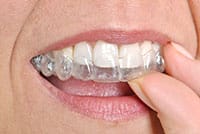 invisalign braces