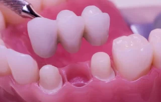 dental bridges
