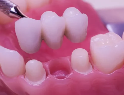 What Is a Dental Bridge and How Does It Work? | Promenade Dental Care Murrieta