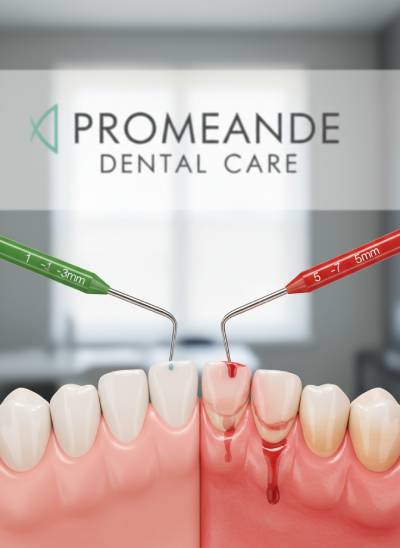 Periodontal gum evaluation before denture fabrication at Promenade Dental Care Murrieta