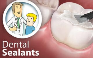 dental sealant for kids