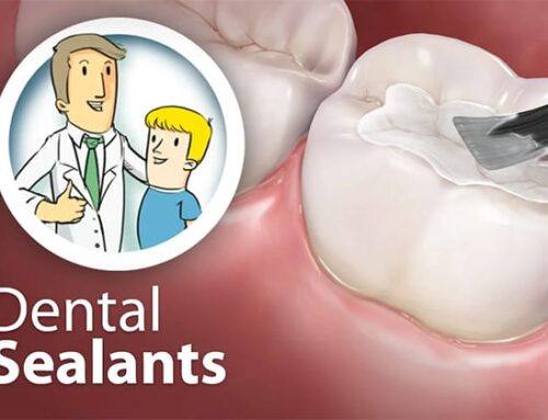 Dental Sealants for Kids: A Parent’s Comprehensive Guide